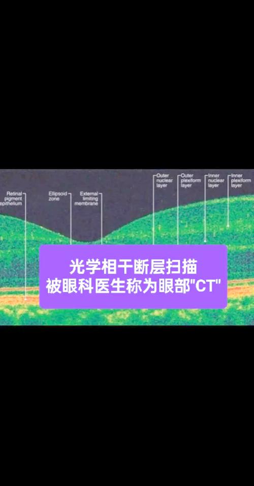 ped是眼科什么缩写:视网膜ped是什么意思