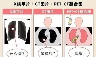 什么是PET-CT检查？全面了解PET-CT的原理、应用及注意事项