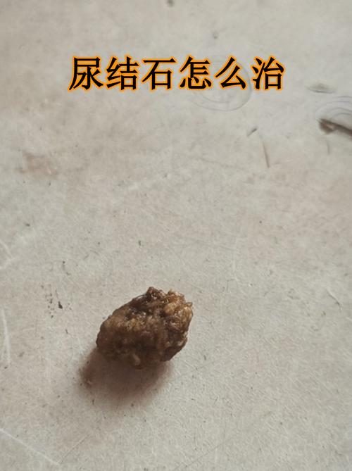 包含男子尿频拖3年取出巨型结石的词条